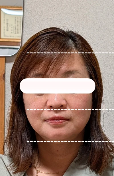 美容鍼1回目施術後の女性の顔正面