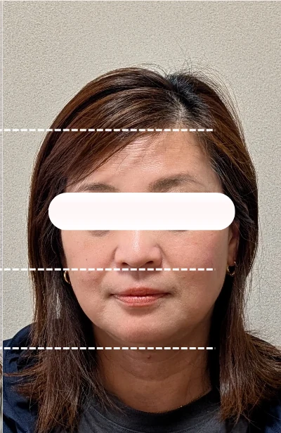 美容鍼4回目施術後の女性の顔正面。フェイスラインが引き締まっている
