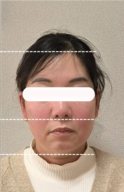 美容鍼1回の施術後。むくみが取れフェイスラインがすっきりしている
