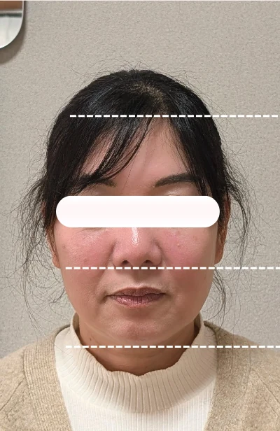 美容鍼施術前の女性の顔正面