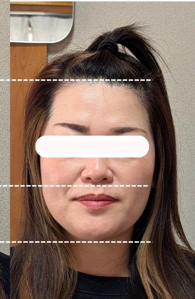 美容鍼1回の施術後。頬が引き上がりフェイスラインが整っている