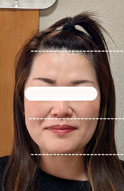 美容鍼施術前の女性の顔正面